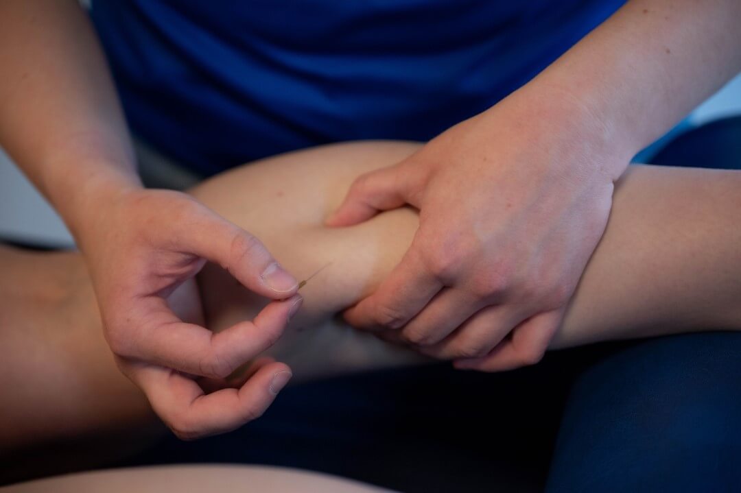 Wat is dry needling therapie?